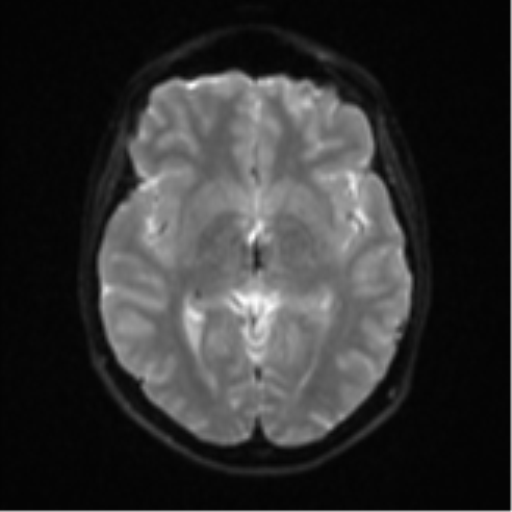 Cerebellar tuberculomas (Radiopaedia 46939-51472 Axial DWI 14).png