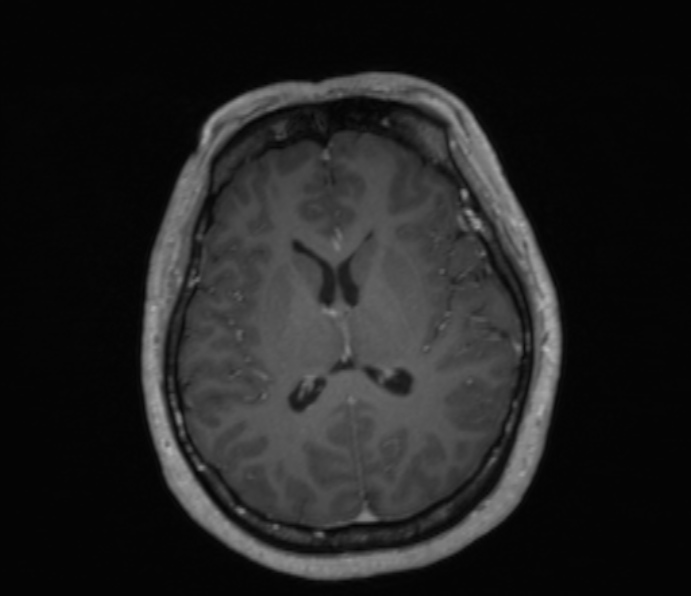 Cerebellopontine angle meningioma (Radiopaedia 35181-36715 Axial T1 C+ 26).jpg