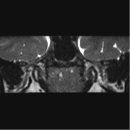 Cerebellopontine angle meningioma (Radiopaedia 48434-53348 Coronal T2 75).png