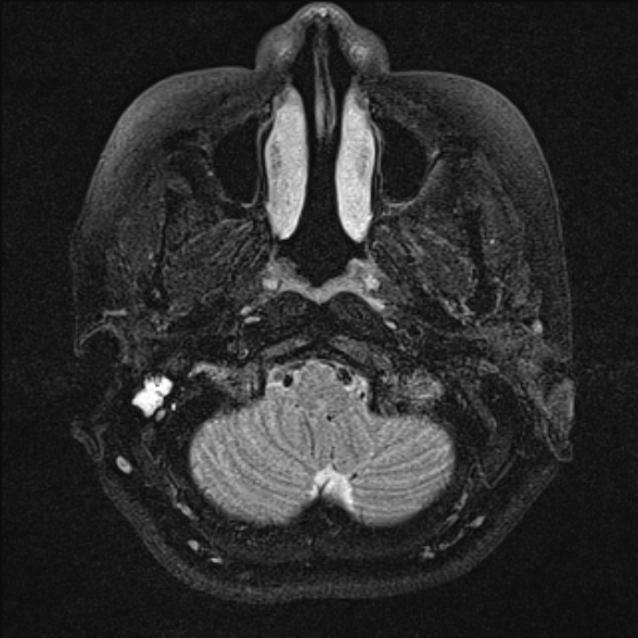 File:Cerebellopontine angle meningioma (Radiopaedia 53561-59591 Axial T2 fat sat 2).jpg