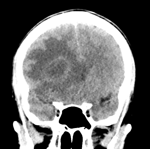 Cerebral abscess (Radiopaedia 60342-68008 Coronal non-contrast 23).png