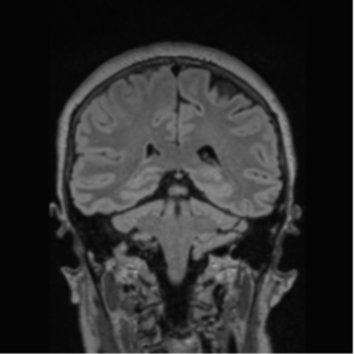 Cerebral abscess from pulmonary arteriovenous malformation (Radiopaedia 86275-102291 Coronal FLAIR 36).png