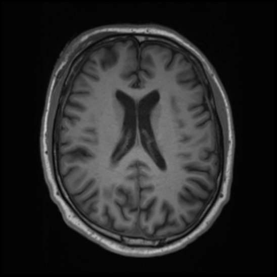 File:Cerebral abscess with ventriculitis (Radiopaedia 78965-91878 Axial T1 30).jpg