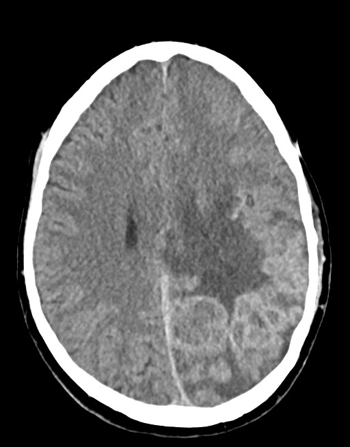 Cerebral abscesses (Radiopaedia 70458-80568 Axial non-contrast 40).jpg