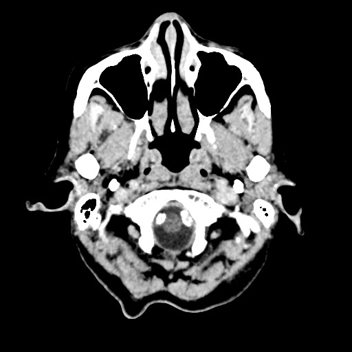 Cerebral amyloid angiopathy-related inflammation (Radiopaedia 74836-85848 Axial non-contrast 7).jpg