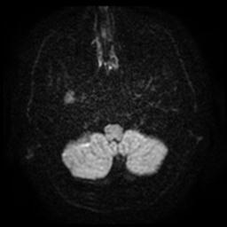Cerebral amyloid angiopathy (Radiopaedia 28698-28978 Axial DWI 4).jpg