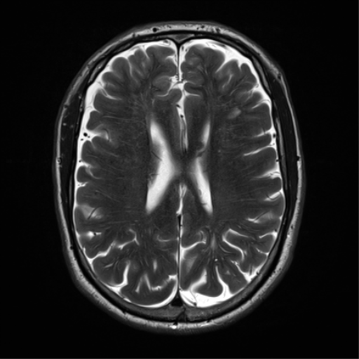 File:Cerebral amyloid angiopathy (Radiopaedia 46082-50433 Axial T2 23).png