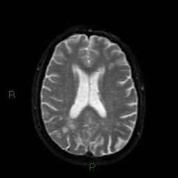 Cerebral amyloid angiopathy (Radiopaedia 77506-89664 Axial DWI 46).jpg