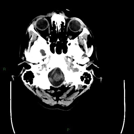 Cerebral amyloid angiopathy (Radiopaedia 77506-89665 Axial non-contrast 12).jpg