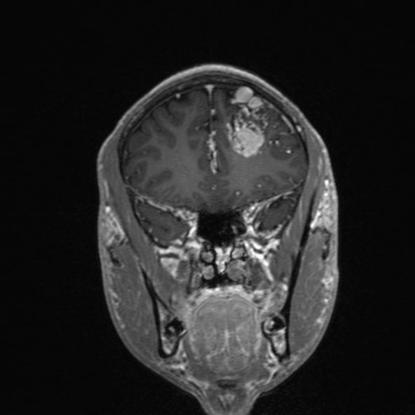 Cerebral arteriovenous malformation (Radiopaedia 30198-30813 F 20).jpg