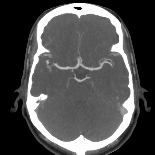 Cerebral arteriovenous malformation (Radiopaedia 39259-41505 AX CEREBRAL CTA 20).png