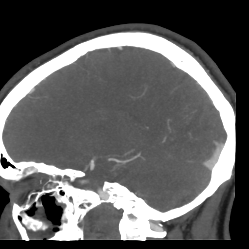 Cerebral arteriovenous malformation (Radiopaedia 39259-41505 Sagittal 38).png