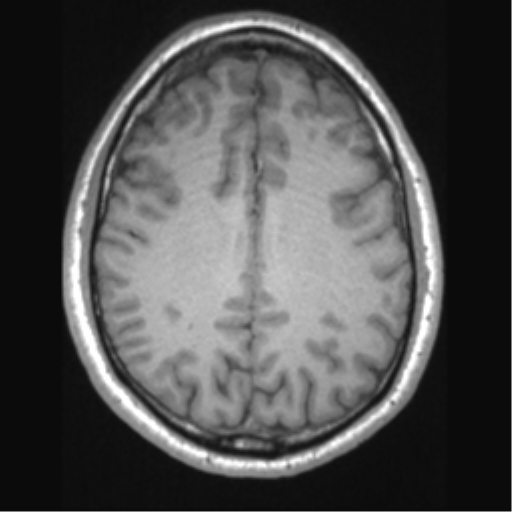 Cerebral arteriovenous malformation (Radiopaedia 39259-41506 Axial T1 52).png