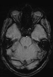 File:Cerebral arteriovenous malformation (Radiopaedia 55798-62372 Axial SWI 12).png