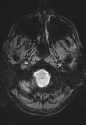 File:Cerebral arteriovenous malformation (Radiopaedia 55798-62372 Axial SWI 2).png