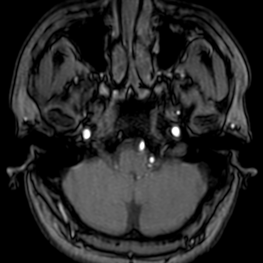 Cerebral arteriovenous malformation at posterior body of corpus callosum (Radiopaedia 74111-84925 Axial MRA 23).jpg