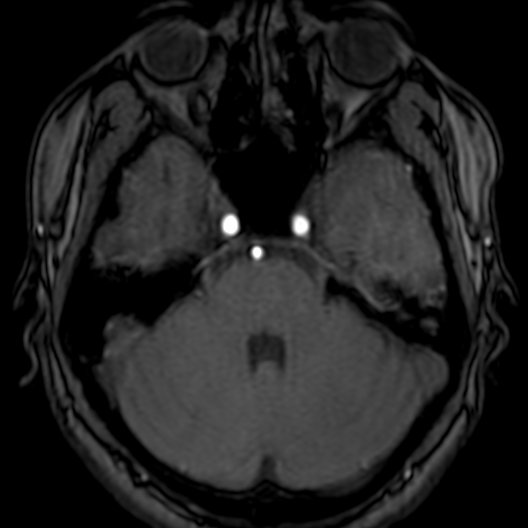 Cerebral arteriovenous malformation at posterior body of corpus callosum (Radiopaedia 74111-84925 Axial MRA 52).jpg