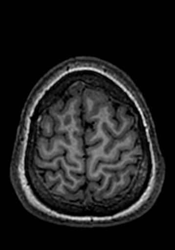Cerebral arteriovenous malformation at posterior body of corpus callosum (Radiopaedia 74111-84925 Axial T1 27).jpg