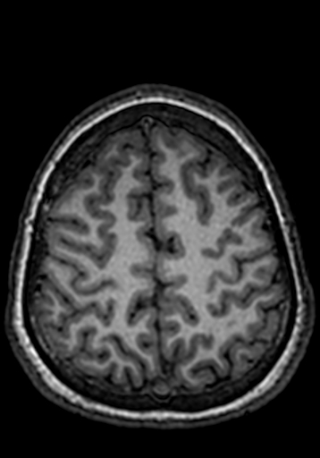File:Cerebral arteriovenous malformation at posterior body of corpus callosum (Radiopaedia 74111-84925 Axial T1 54).jpg
