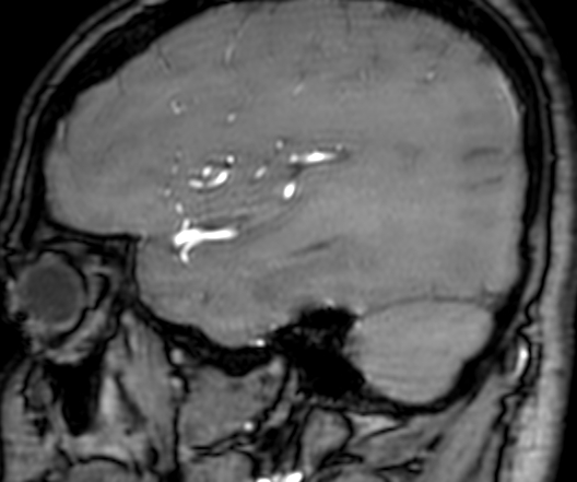 Cerebral arteriovenous malformation at posterior body of corpus callosum (Radiopaedia 74111-84925 J 77).jpg