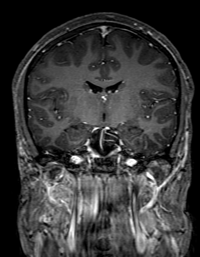 Cerebral arteriovenous malformation at posterior body of corpus callosum (Radiopaedia 74111-84925 K 176).jpg
