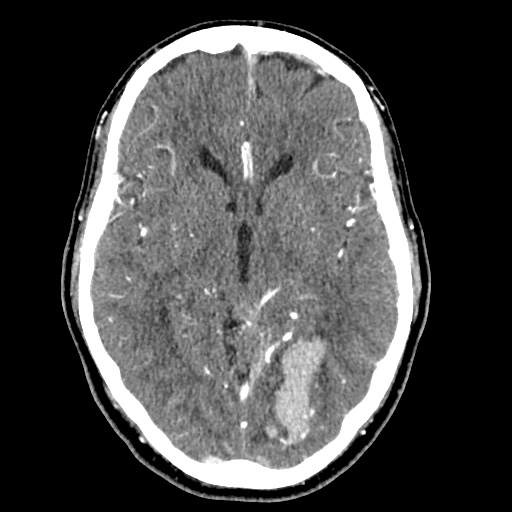 File:Cerebral arteriovenous malformation with lobar hemorrhage (Radiopaedia 35598-57216 A 28).jpg