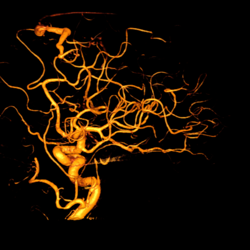 Cerebral arteriovenous malformation with lobar hemorrhage (Radiopaedia 44725-48513 Lateral 26).png
