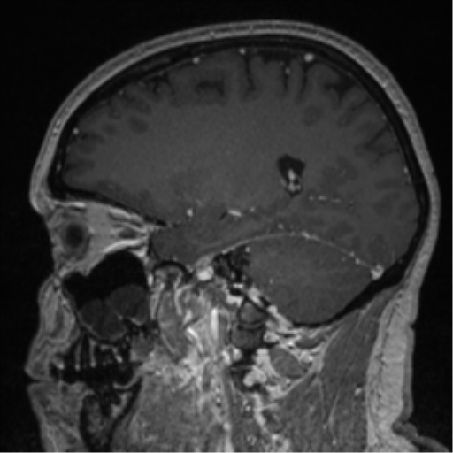 Cerebral cavernoma and development venous anomaly (Radiopaedia 37603-39482 Sagittal T1 C+ 61).png