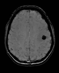 Cerebral cavernous venous malformation (Radiopaedia 70008-80021 I 51).jpg