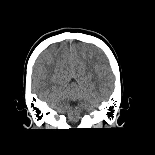 Cerebral cavernous venous malformation (Radiopaedia 70008-80022 non-contrast 50).jpg