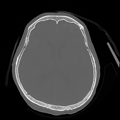 Cerebral contusions, subarachnoid hemorrhage and subdural hygromas (Radiopaedia 55399-61827 Axial bone window 29).png