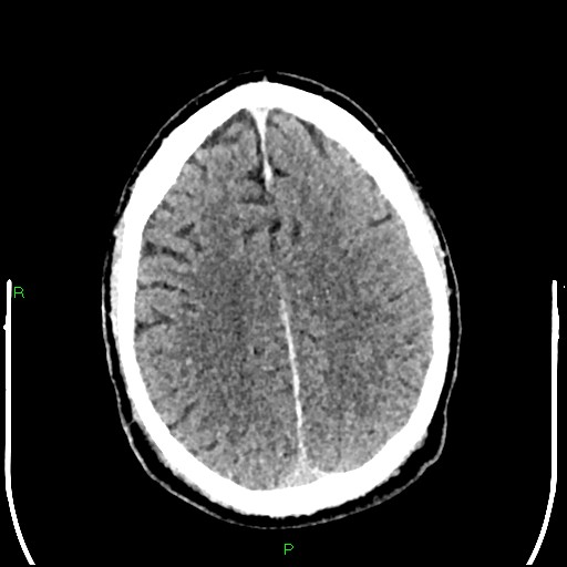 Cerebral contusions (Radiopaedia 33868-35039 Axial non-contrast 153).jpg