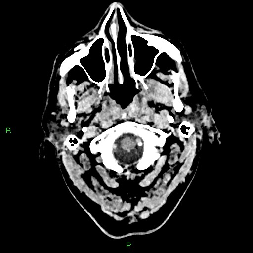Cerebral contusions (Radiopaedia 33868-35039 Axial non-contrast 8).jpg