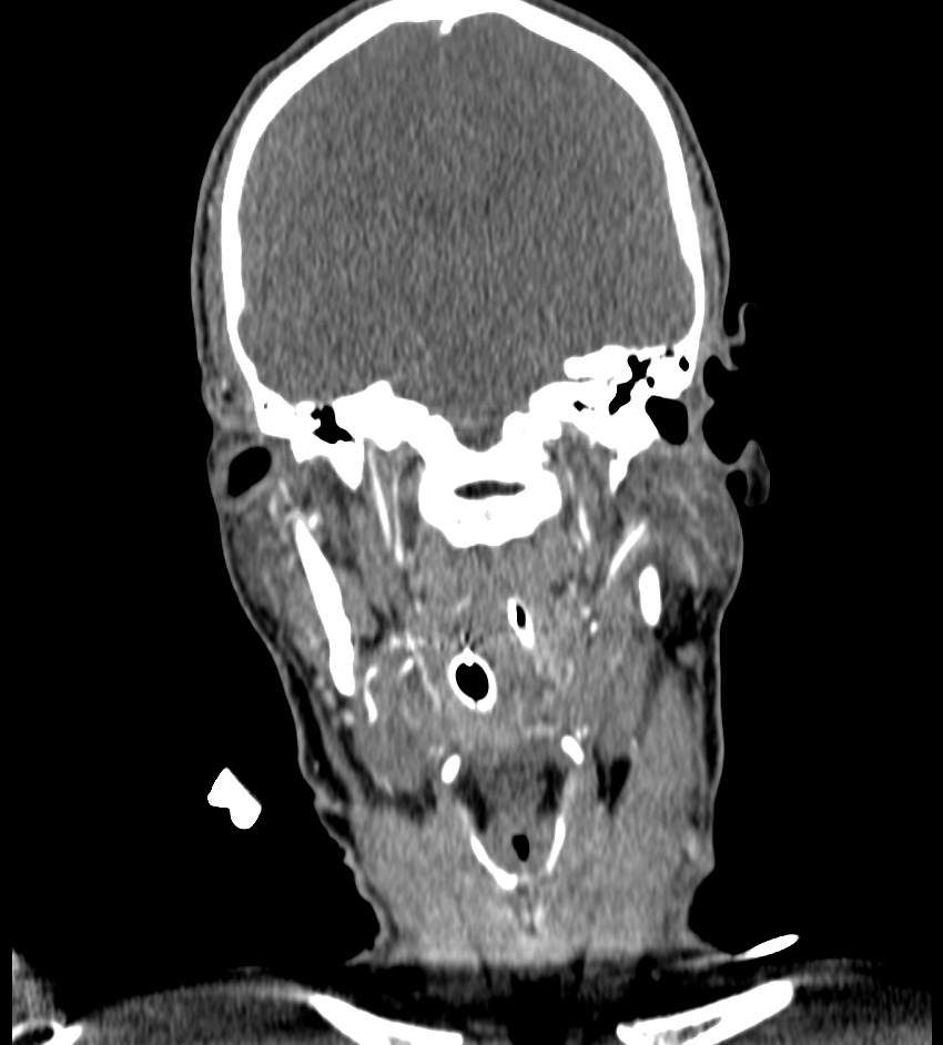 Cerebral edema in an overdose patient (Radiopaedia 72005-82539 B 62).jpg