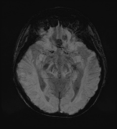 Cerebral embolic infarcts (embolic shower) (Radiopaedia 72391-82921 Axial SWI 30).jpg