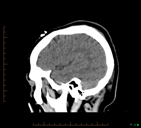 Cerebral fat embolism (Radiopaedia 85521-101220 B 13).jpg