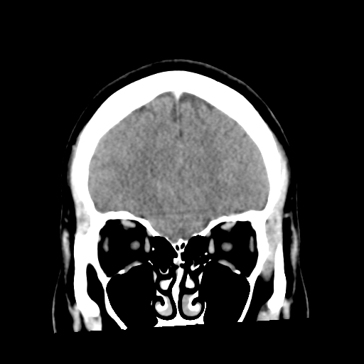 File:Cerebral hemorrhage secondary to arteriovenous malformation (Radiopaedia 33497-34561 C 15).png