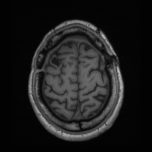 File:Cerebral hemorrhagic contusions- temporal evolution (Radiopaedia 40224-42757 Axial T1 66).png