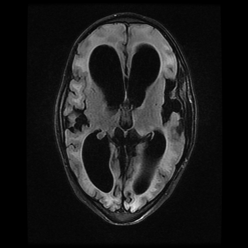 File:Cerebral manifestations of mucopolysaccharidosis type I (Radiopaedia 59171-66487 Axial FLAIR 10).jpg