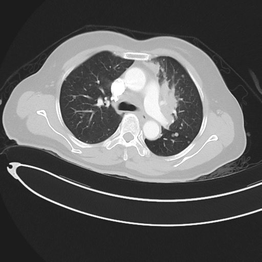 Cerebral metastases (Radiopaedia 33041-34055 Axial lung window 21).png