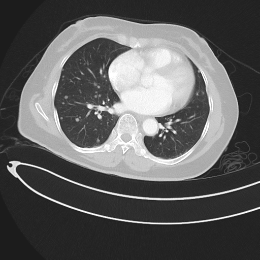 Cerebral metastases (Radiopaedia 33041-34055 Axial lung window 34).png