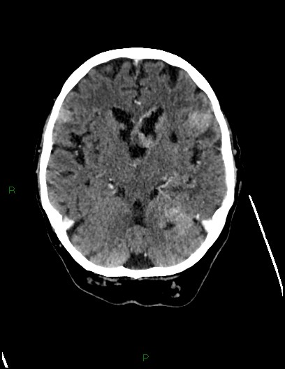 Cerebral metastases - ependymal and parenchymal (Radiopaedia 79877-93131 Axial C+ delayed 32).jpg