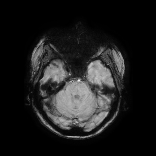 Cerebral metastases - melanoma (Radiopaedia 80972-94522 Axial SWI 30).jpg