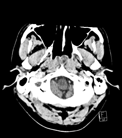 Cerebral metastases - testicular choriocarcinoma (Radiopaedia 84486-99855 Axial C+ delayed 49).jpg