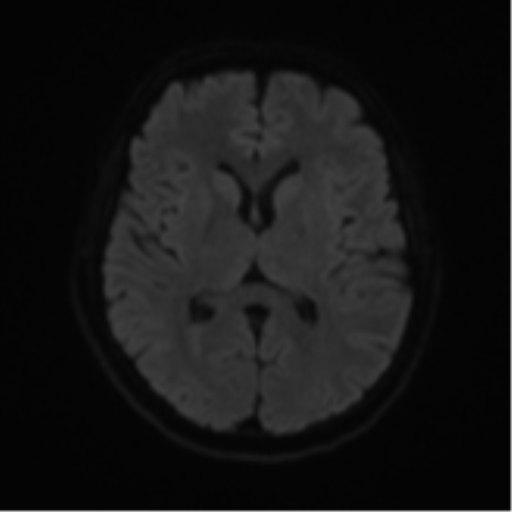 Cerebral metastases mimicking abscesses (Radiopaedia 45841-50131 Axial DWI 44).png