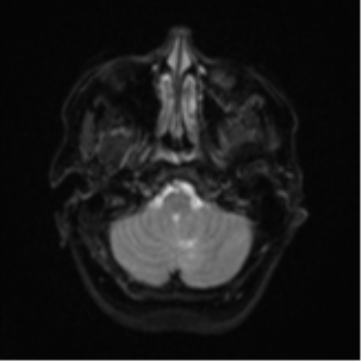 Cerebral metastases mimicking abscesses (Radiopaedia 45841-50131 Axial DWI 6).png
