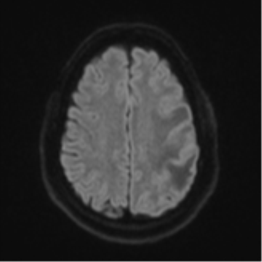Cerebral metastases mimicking multifocal glioblastoma (Radiopaedia 50843-56353 Axial DWI 47).png