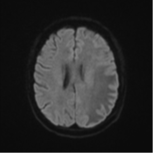 File:Cerebral metastasis (Radiopaedia 46744-51248 Axial DWI 46).png