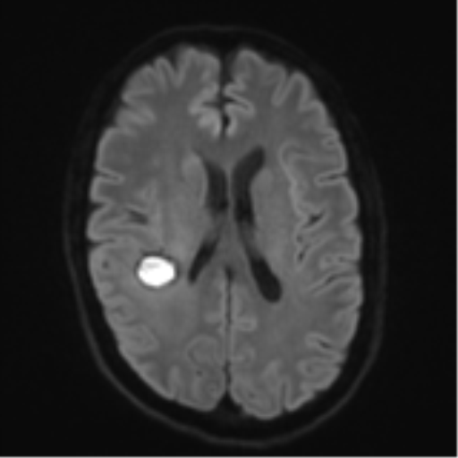 Cerebral metastasis - melanoma (Radiopaedia 54718-60954 Axial DWI 48).png