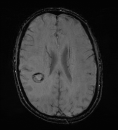 File:Cerebral metastasis - melanoma (Radiopaedia 54718-60954 Axial SWI 36).png